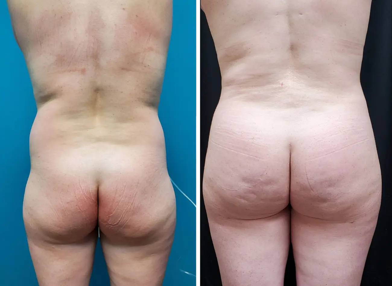 Before and After Gallery: BBL Banner