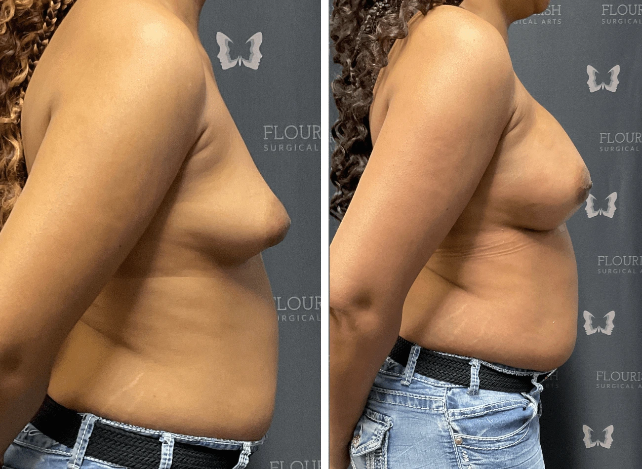 Breast Aug 3.2