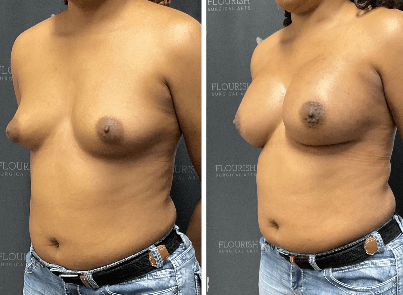 Breast Aug 3.4