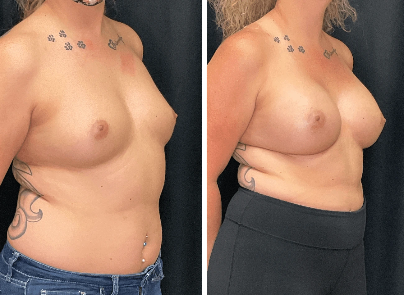 Breast Aug 4.1