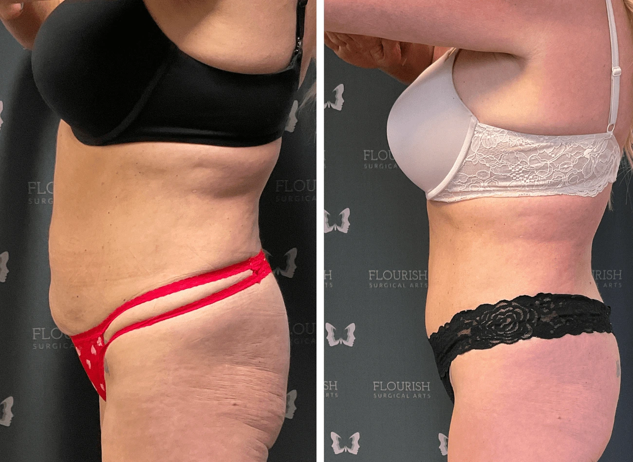 Lipo 2.1