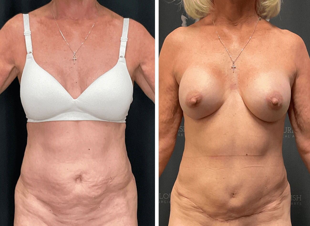 Lipo 3