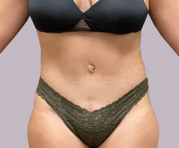 tummy-gallery01-after