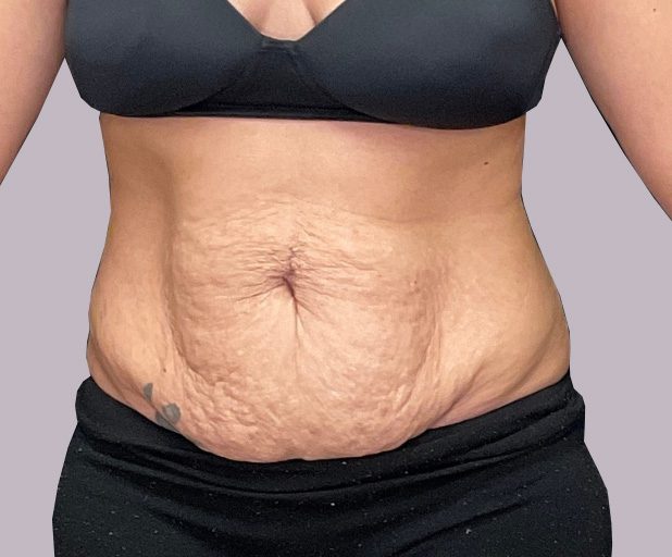 tummy-gallery01-before
