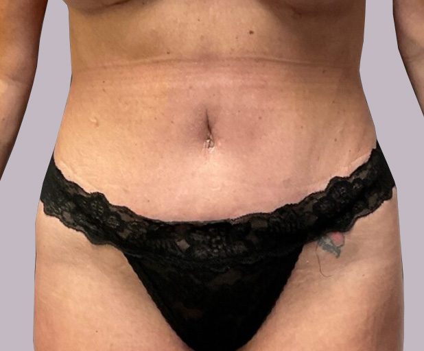 tummy-gallery02-after