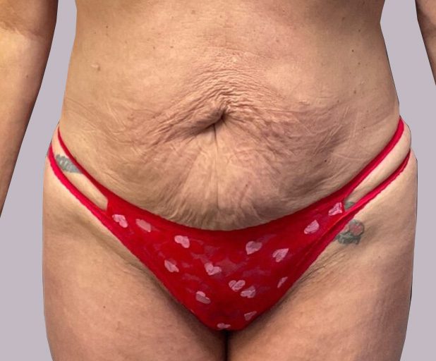 tummy-gallery02-before
