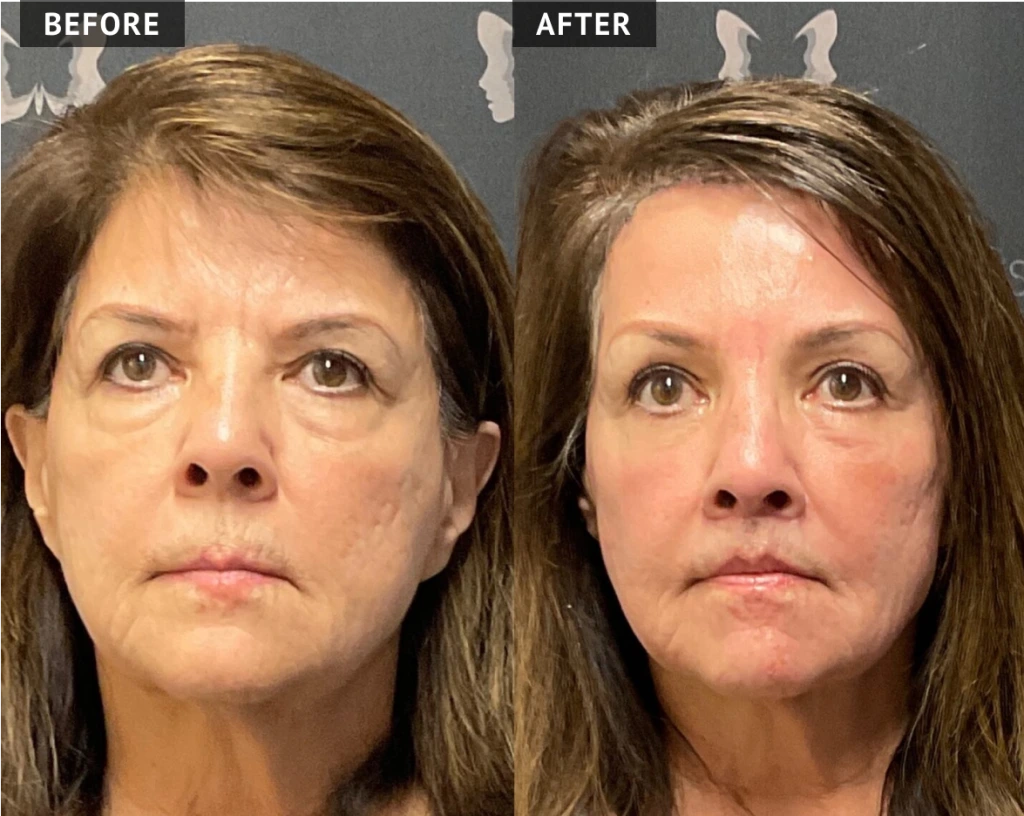 Before & After Our Brow Lift Banner