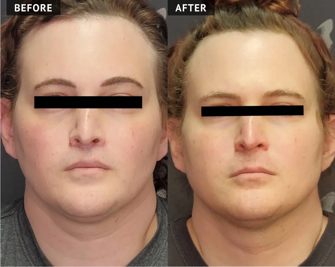 Ftm Before And After 22 Year Old FtM Patient With A BMI Of 40 62 Kg m Ftm Before And After 22 Year Old FtM Patient With A BMI Of 40 62 Kg m