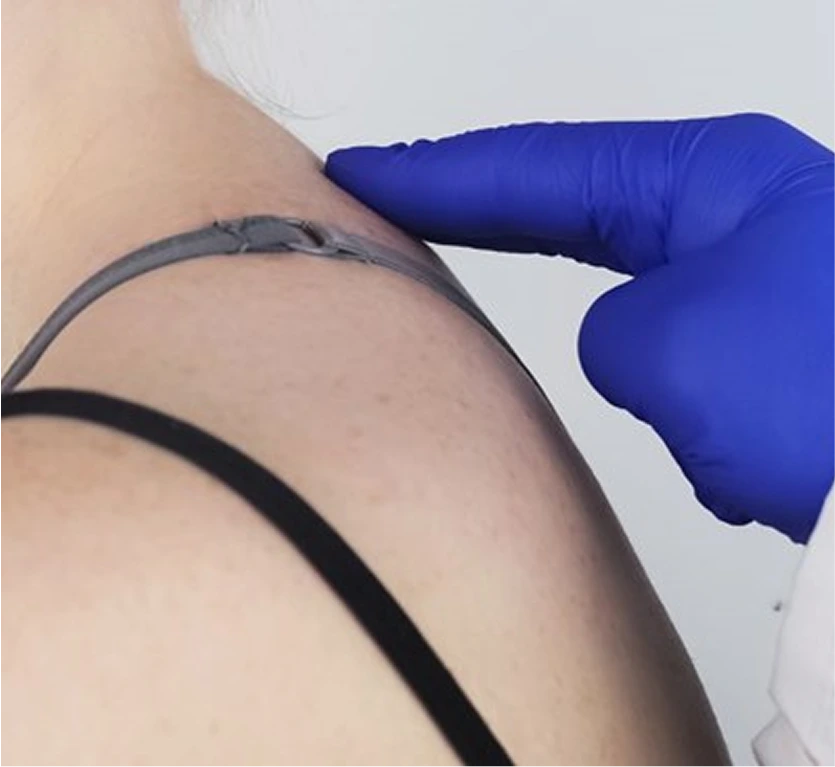 Recovery After Buffalo Hump Liposuction in Denver, Colorado Banner