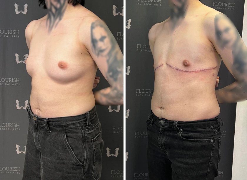 Before and After Gallery: Breast Lift