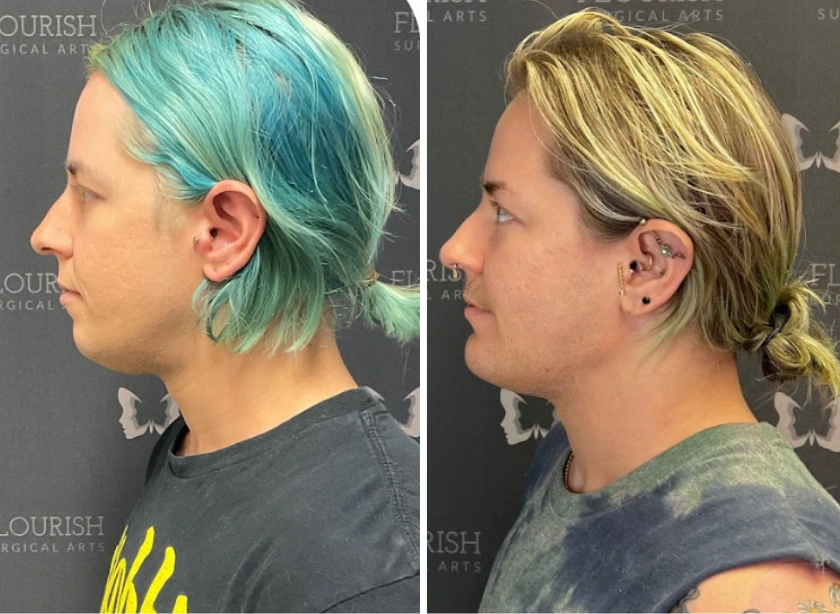 Before and After Gallery: Jaw Implant