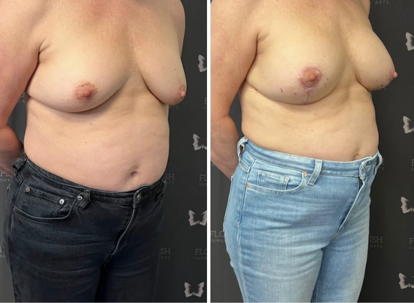 Before and After Gallery: Tummy Tuck
