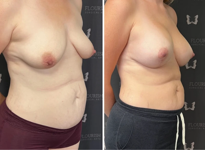 Breast Aug with Lift - Case 1 (2)