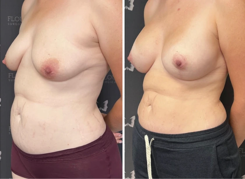 Breast Aug with Lift - Case 1 (3)