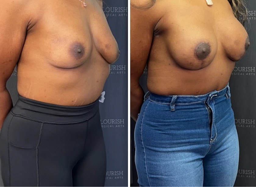 Breast Aug with Lift - Case 2 (2)