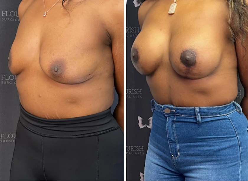 Breast Aug with Lift - Case 2