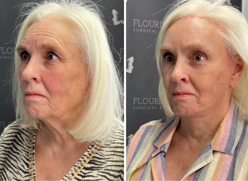 Full Face and Neck Lift (2)