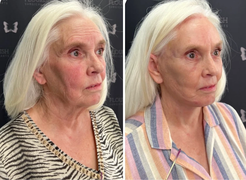 Full Face and Neck Lift (3)