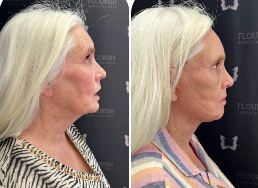 Full Face and Neck Lift (4)