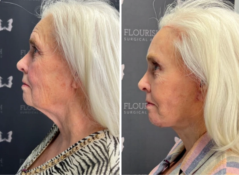 Full Face and Neck Lift (5)