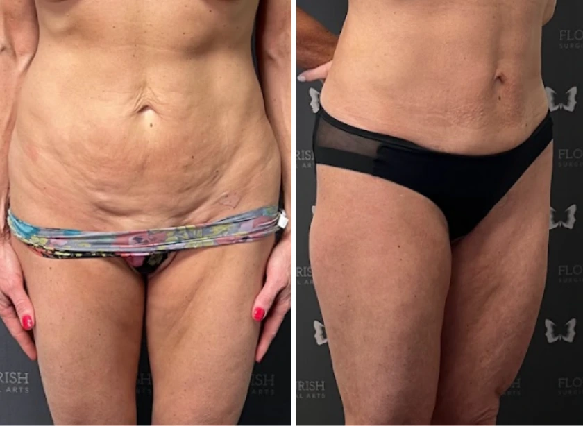 Mini Tummy Tuck (3)