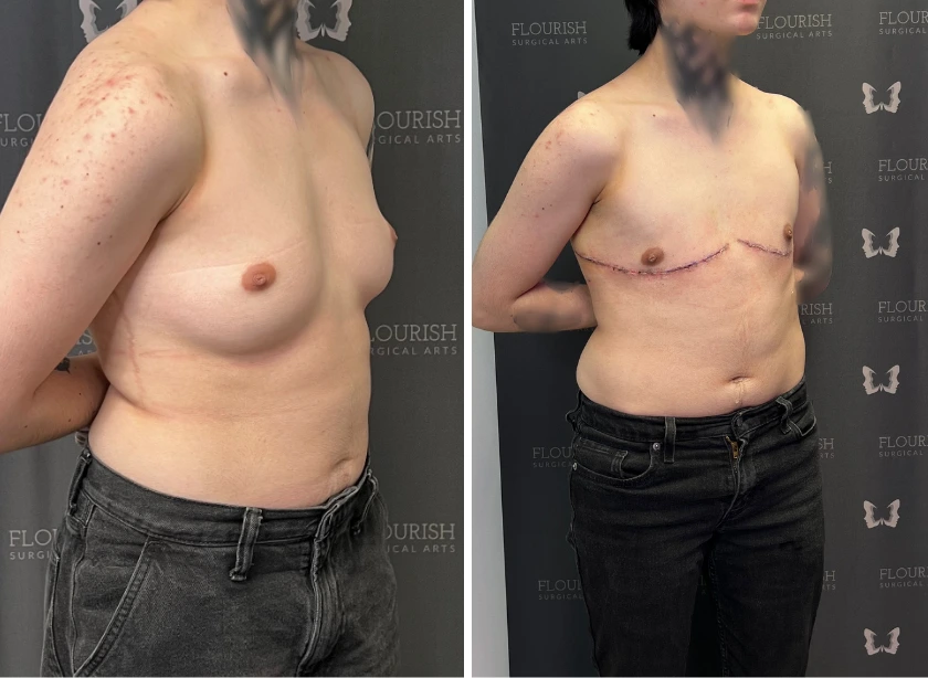 Nipple Preservation Top Surgery (2)