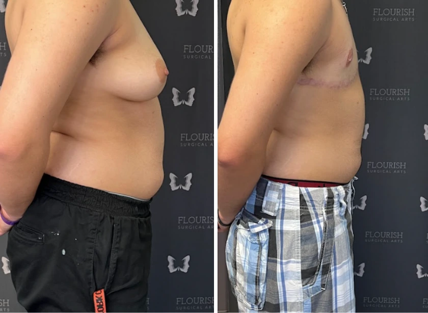 Top Sx With Free Nipple Graft - Case 1 (4)