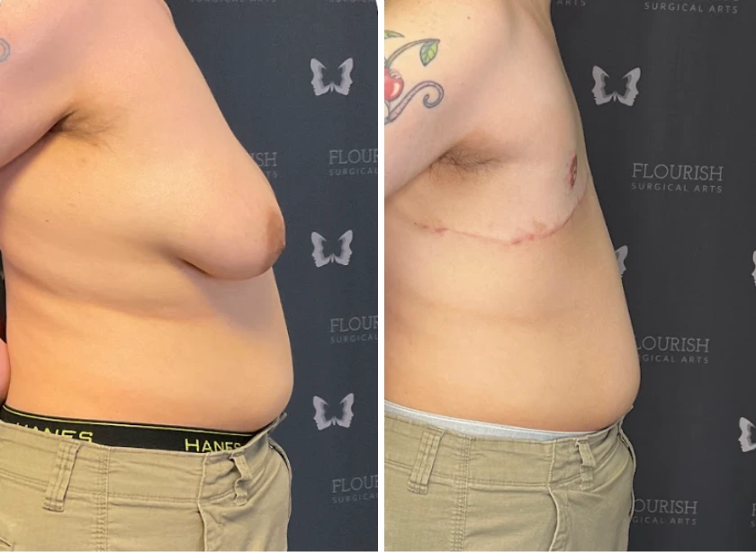 Top Sx With Free Nipple Graft - Case 2