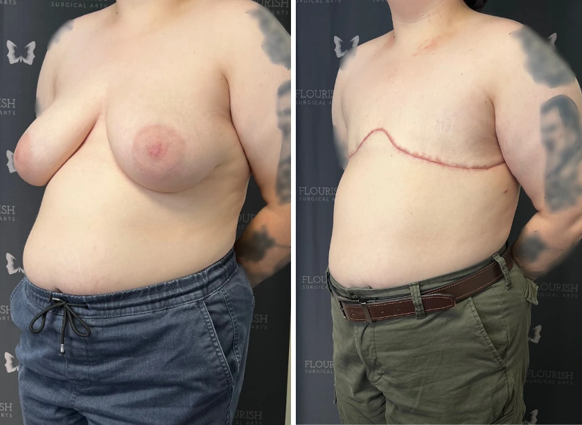 Top Sx Without Free Nipple Graft (3)