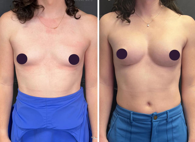 Before & After Gallery: Breast Implant Banner